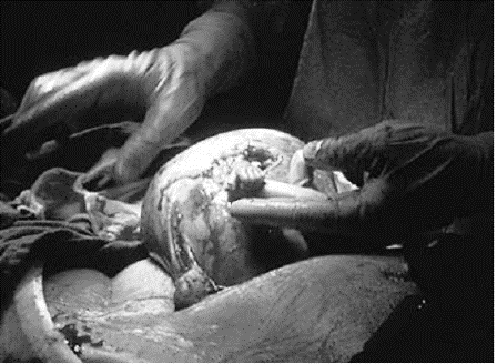 picture of baby in womb being operated on at 21 weeks